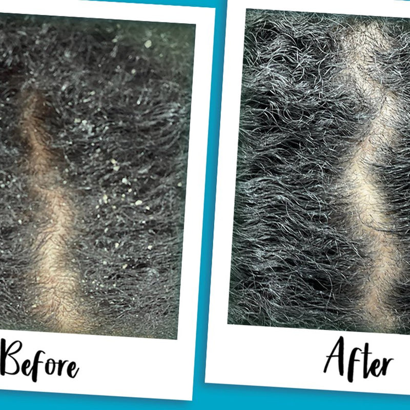 FLAKY SCALP: TRICHOLOGIST TIPS ON WHAT IT IS AND HOW TO FIX IT