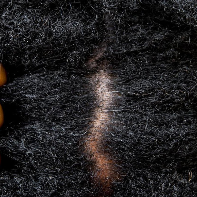 Why Is My Scalp Itchy? Trichologist Explains It All